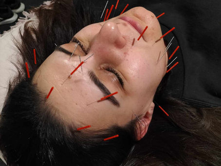 Revitalize Your Skin with Cosmetic Acupuncture