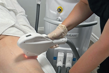 Laser Hair Removal from Leg