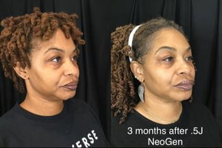 Before and after NeoGen PSR treatment at 0.5J showing reduced under-eye puffiness, firmer mid-face skin, and improved tone after three months