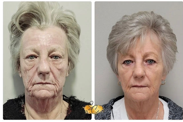 Femme âgée avant et après avoir reçu la thérapie NeoGen PSR, avec une amélioration spectaculaire du relâchement cutané, de la texture et de la fermeté visible du visage.