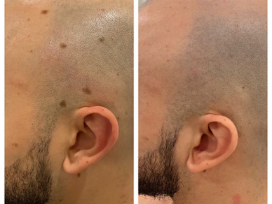 Before and after Plexr Plus treatment for scalp lesion reduction on a bald male head.