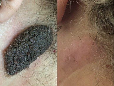 Before and after Plexr Plus treatment for scalp lesion reduction on a bald male head.