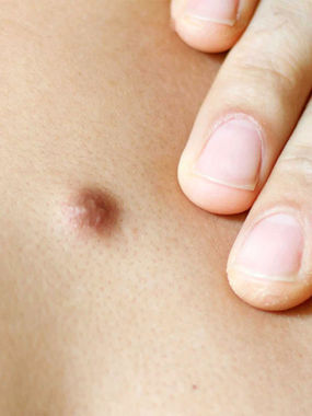 Raised benign skin lesion before Plexr Plus treatment for non-surgical removal of moles, skin tags, and other superficial lesions