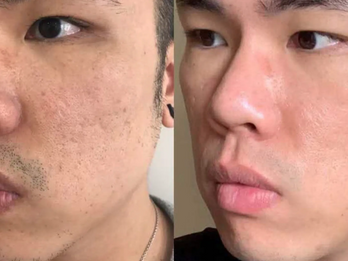 Improvement in acne scars and smoother skin texture after NeoGen PSR treatment at NewGen Skin in New Liskeard.