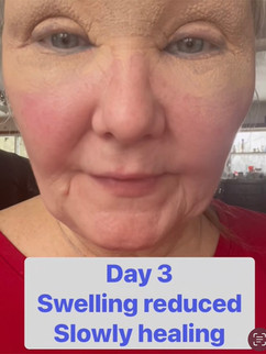 Day 3 post-Plexr Plus treatment showing a woman's face with reduced swelling. Skin appears tighter and healing, especially around the eyes and cheeks. Text overlay notes 'Swelling reduced, Slowly healing.