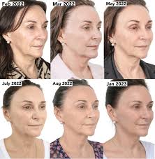 Progressive timeline of a woman’s face from February 2022 to January 2023, showing monthly improvements after NeoGen PSR treatment. Visible enhancements include firmer skin, reduced wrinkles, smoother texture, and a more youthful facial contour over time.