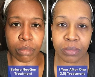 NeoGen PSR before and after showing smoother skin, firmer texture, and even tone one year after a single 0.5J nitrogen plasma treatment