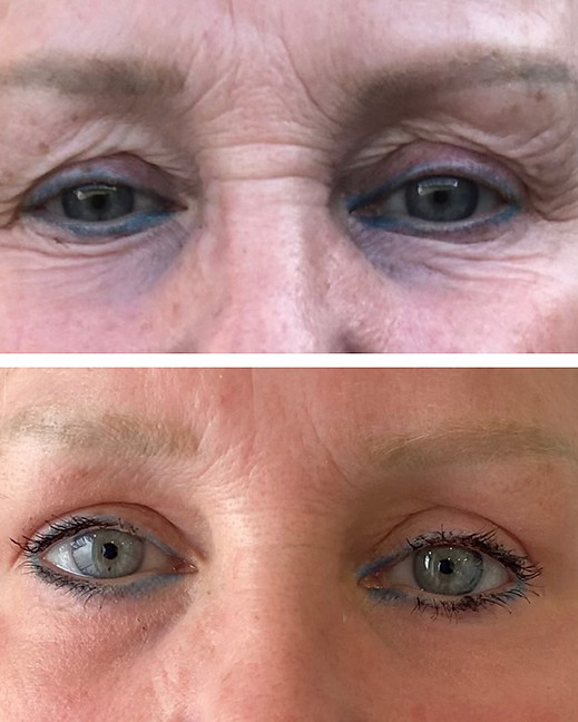 "Before and after photos of a female client's eyes showing reduced wrinkles and tighter skin after non-surgical treatment at NewGen Skin with Plexr Plus