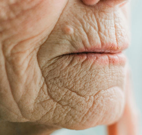 Severe perioral wrinkles around mouth shown before Plexr Plus treatment to reduce smoker’s lines and restore youthful skin texture