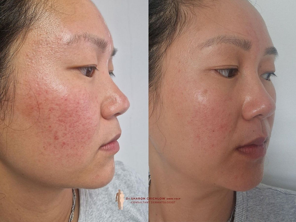 Facial Redness Treatment with Laser Genesis