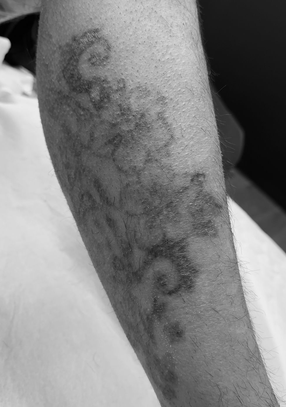ARS ETERNA REMOVAL - Eliminación láser de tatuajes en Sevilla