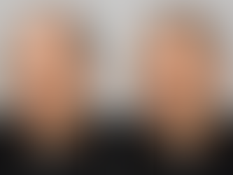 Scalp Micropigmentation Results