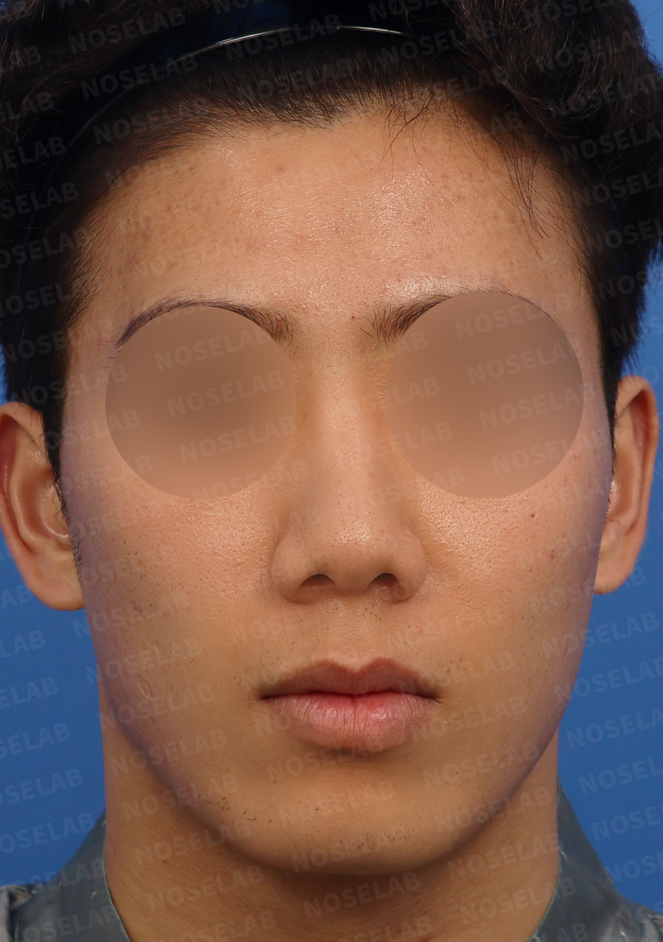 Frontal view of Asian male patient before Closed Rhinoplasty Korea, showing nasal deviation, wide nose tip, and retracted columella.