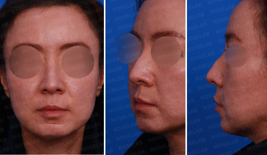 Design consultation – frontal, left oblique, and side views before droopy nose and hump correction rhinoplasty.