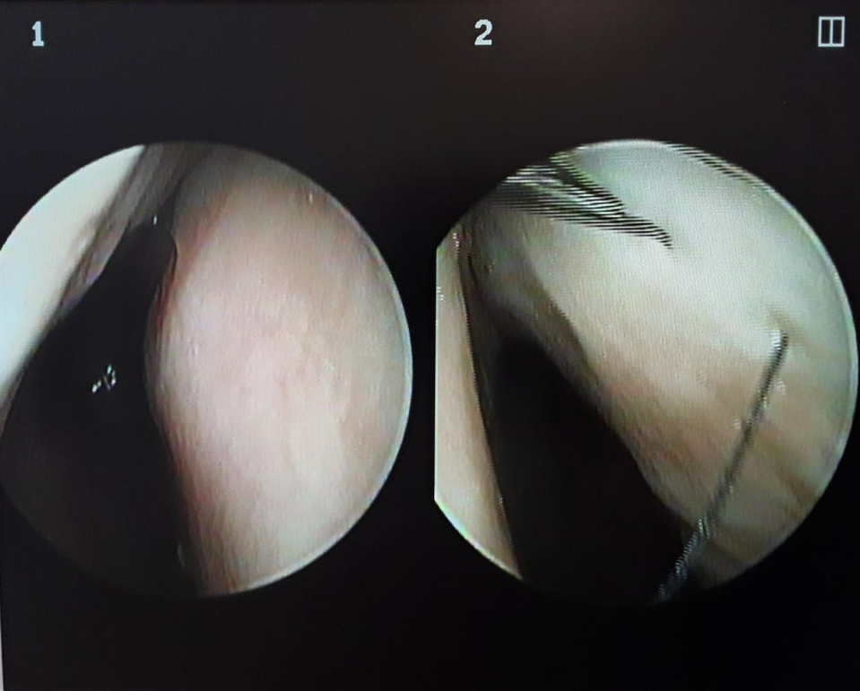 Intranasal endoscopy images: right side (1) and left side (2).