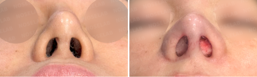 Silitex implant removal rhinoplasty revision – nostril view before surgery (left) and immediately after surgery (right)