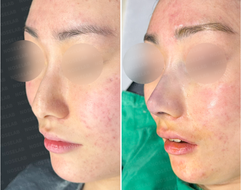 Oblique side view before and after closed rhinoplasty Korea – improved nasal symmetry, tip refinement, and softer facial contour using rib cartilage.