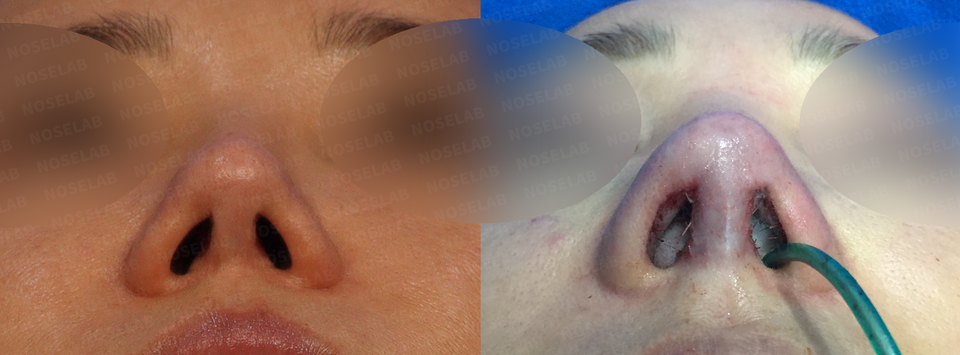 Closed Rhinoplasty Korea Mild Contracted Blunt Nose before and after basal view – improved nostril symmetry and natural alar base contour using self rib cartilage by Dr. Cha-Young Kang, NoseLab Clinic