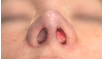 Silitex implant removal rhinoplasty revision – immediate postoperative nostril view