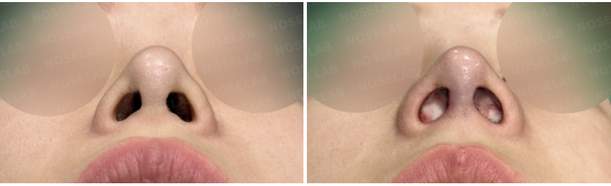 Before and after short nose correction — nostril view showing improved nasal symmetry, reduced nostril exposure, and stable columella support.
