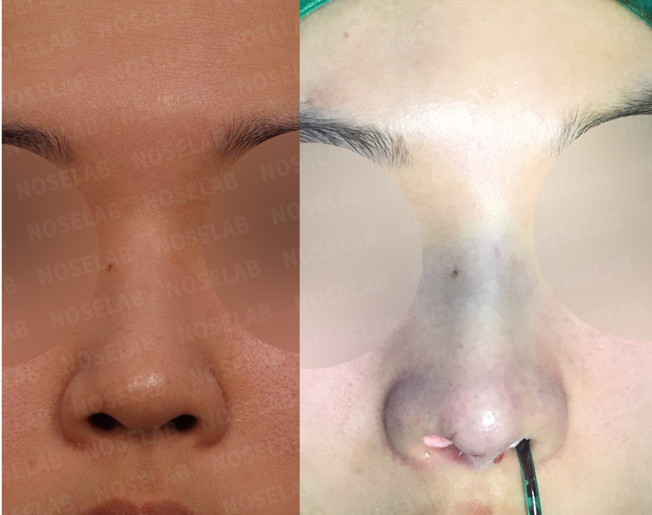 Frontal before-after comparison demonstrating improved nasal symmetry and reduced nostril visibility