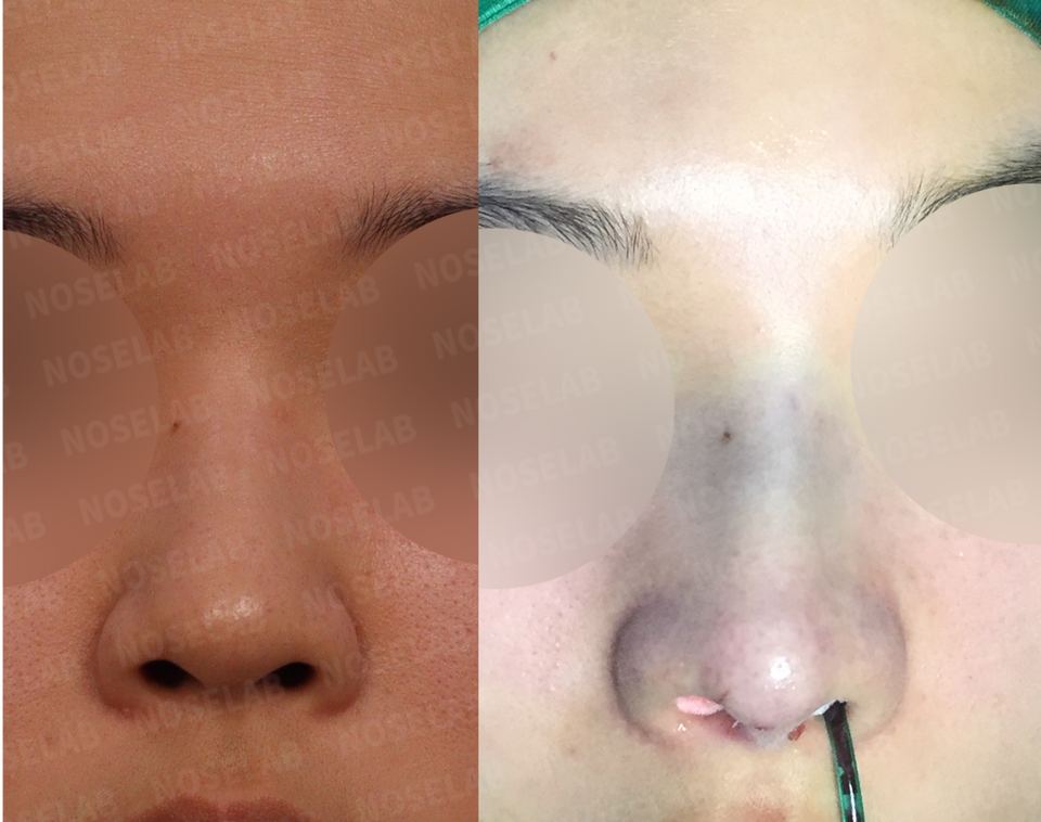 closed rhinoplasty Korea before and after frontal view – correction of short and hump nose, improved nasal symmetry and reduced nostril exposure