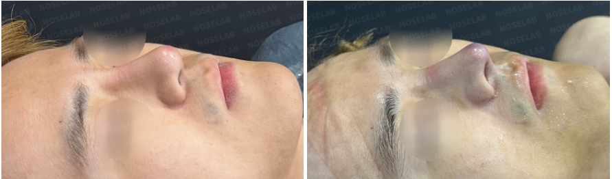 before and after 45-degree view of silicone exposure rhinoplasty showing improved nasal contour, reduced swelling, and smoother nasal line after closed rhinoplasty Korea