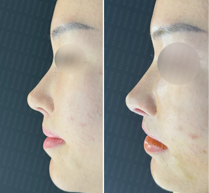 efore (left) and immediately after (right) customized rhinoplasty with specific requests – left side profile showing improved columella position, refined nasal tip, and maintained dorsal height.