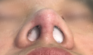 Nostril photo taken right after the surgery.