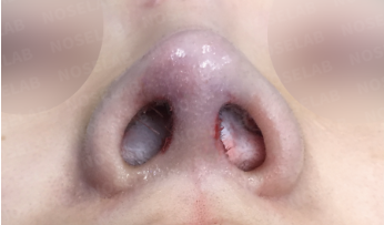Short nose rhinoplasty – immediate postoperative nostril view photo