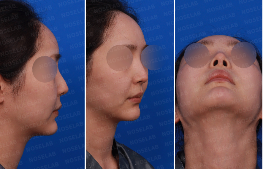 Correcting Drooping Nasal Tip and Nasal Obstruction – Right Side, Oblique Side, and Nostril View before rhinoplasty at Nose Lab Clinic