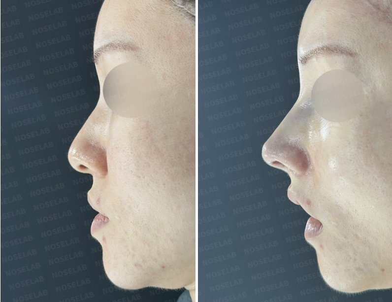 Side profile of a female patient before surgery (left) and immediately after surgery (right), showing changes in nasal projection and tip alignment at NoseLab Clinic.