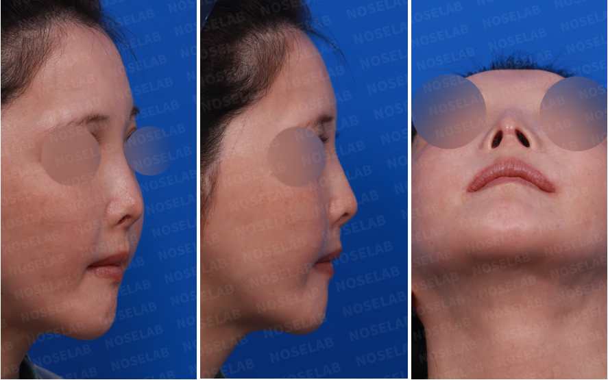 Pre-surgery consultation photos showing right oblique, right profile, and nostril views before contracted nose revision rhinoplasty.