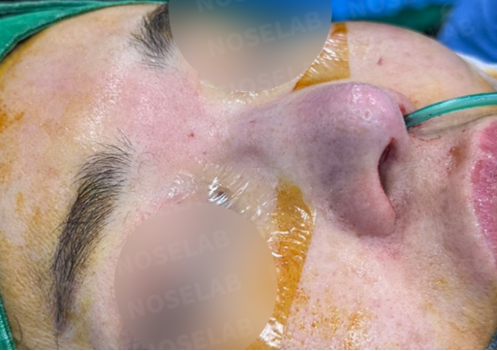 Intraoperative nasal view after foreign object removal, showing septum and tissue condition
