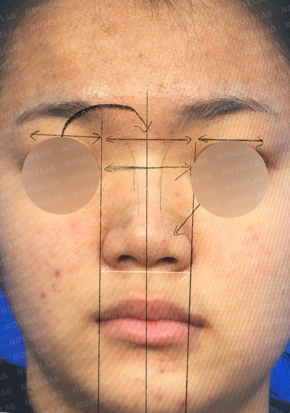 Frontal view documentation showing nasal width and symmetry evaluation before rhinoplasty