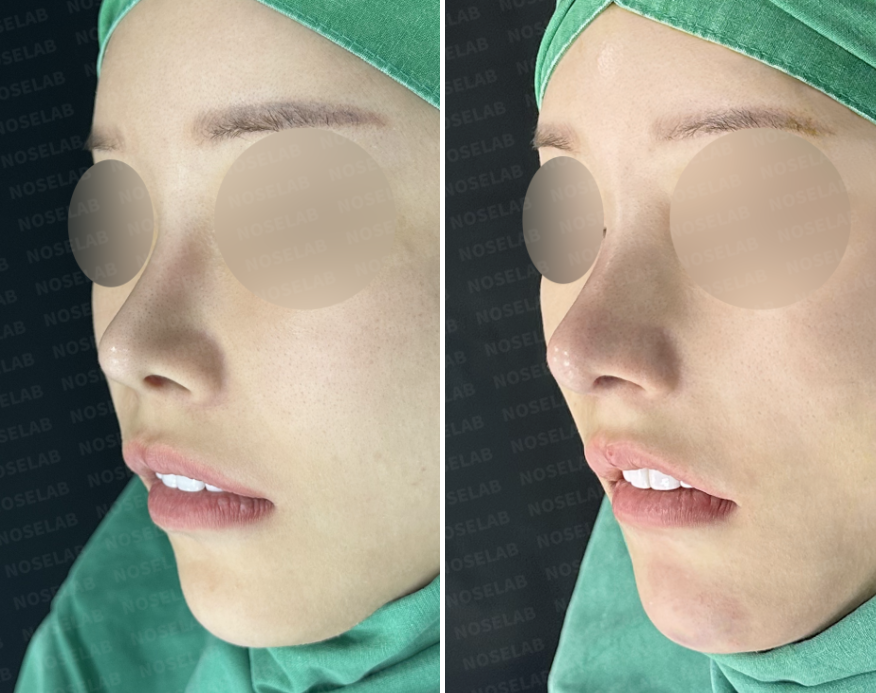 Before and after short nose correction — oblique side view showing natural nasal tip extension, smooth bridge contour, and improved facial harmony.