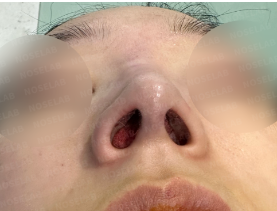 Nostril photo after surgery.