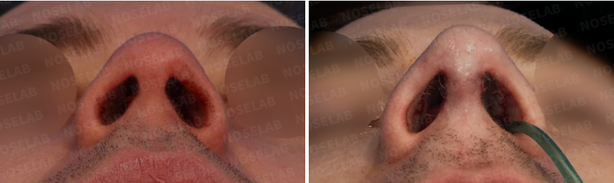 Nostrils before surgery (left) after surgery (right)