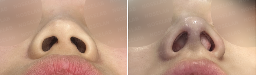 Before and immediately after surgery basal view showing improved nostril symmetry and refined nasal base following implant-free closed rhinoplasty with rib cartilage reconstruction.