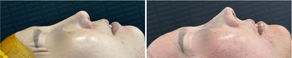 Before and After Surgery Photos. Before surgery (left), after surgery (right)