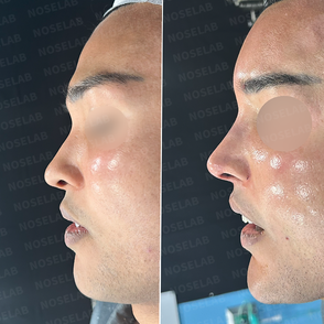 Side profile before and after deviated septum and wide nose correction – improved nasal bridge and tip using autologous rib cartilage