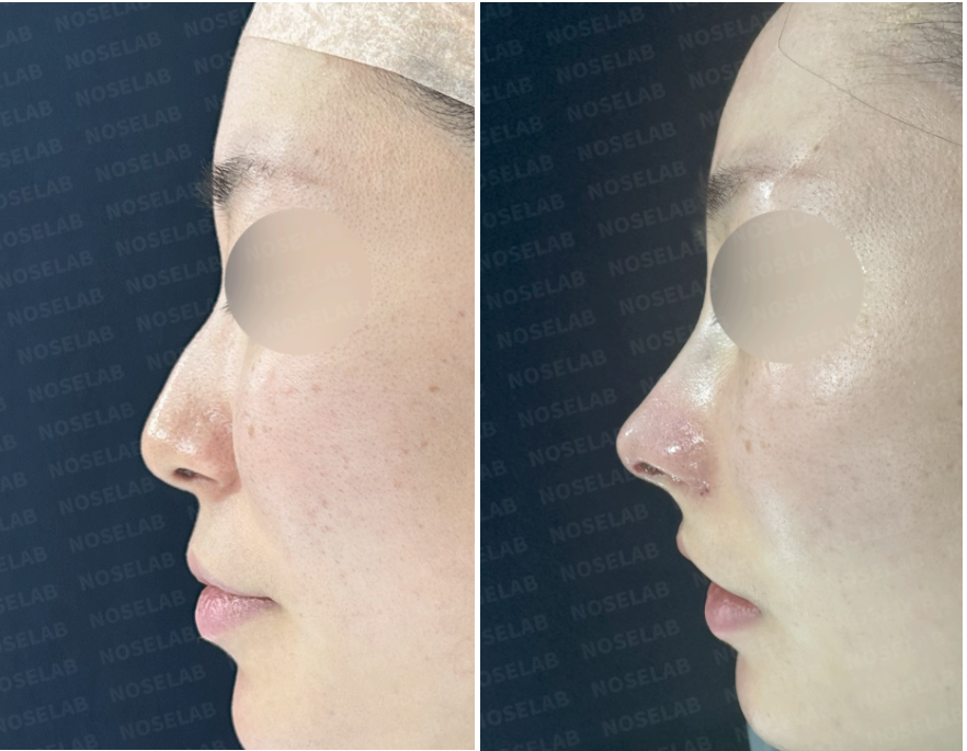 Side view before (left) and immediately after (right) hump nose and deviated nose correction – Nose Lab Clinic