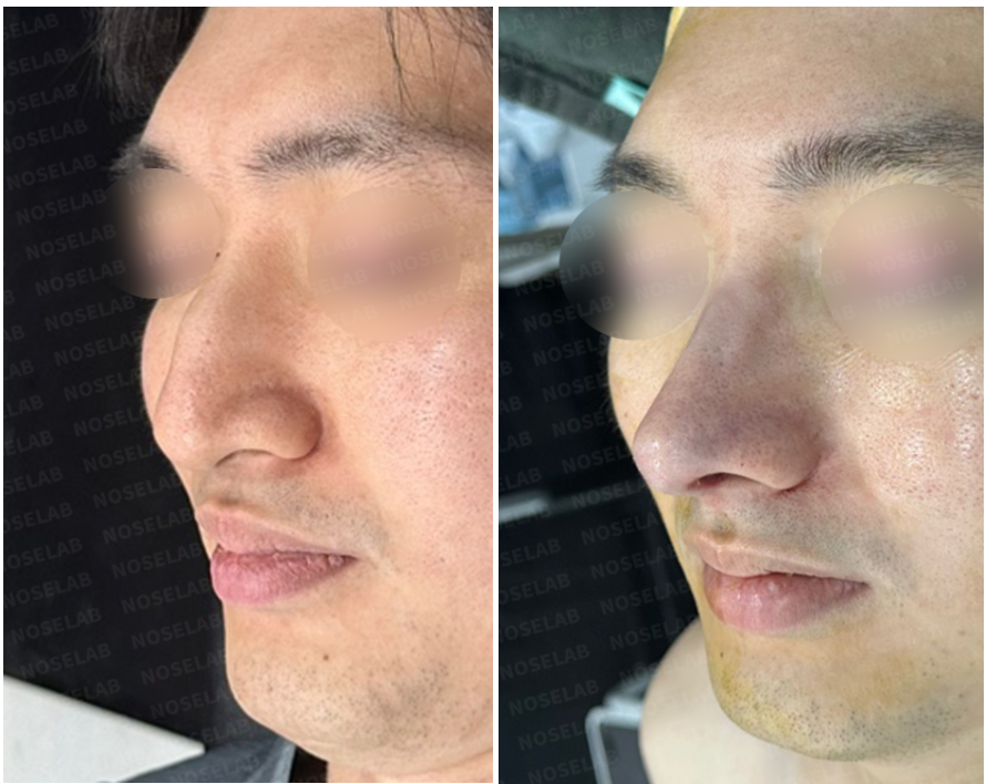 Oblique view comparison before and after dorsal hump correction with rib cartilage – enhanced nasal contour and refined tip projection.