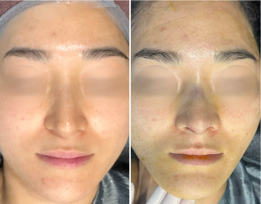 Frontal view before surgery (left) after surgery (right)