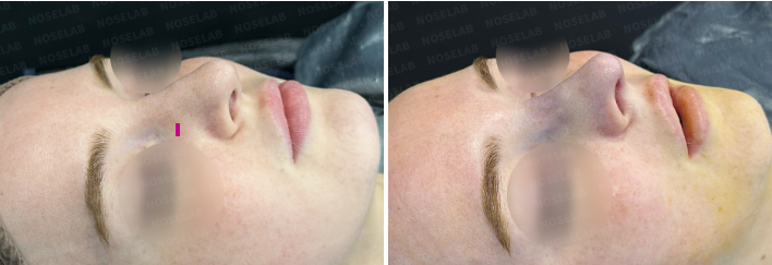 45-degree angle view before surgery (left) after surgery (right)