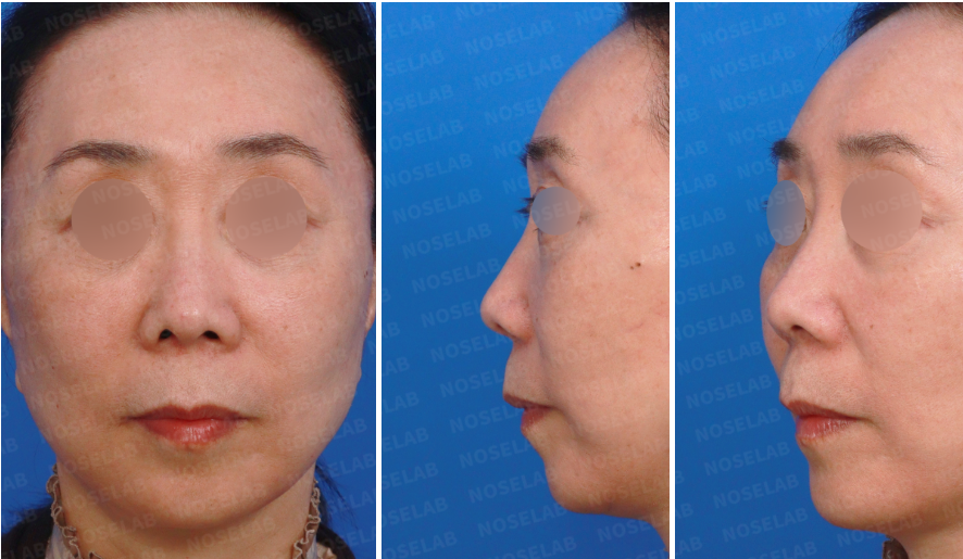 Preoperative design consultation photos showing frontal view, left oblique view, and left side view before closed rhinoplasty Korea, documenting nasal tip shape, bridge contour, and facial balance prior to surgery.