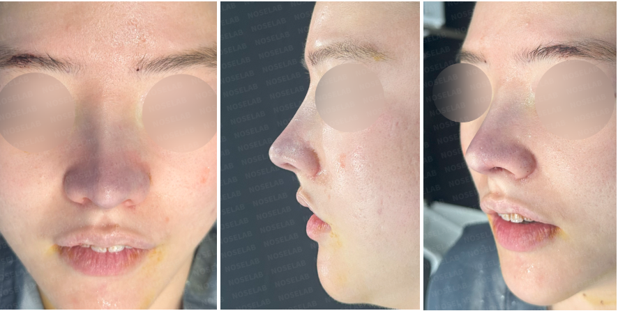 "Post-operative photos of a patient at Nose Lab Clinic, showing frontal, side, and oblique side views immediately after bulbous nose correction surgery