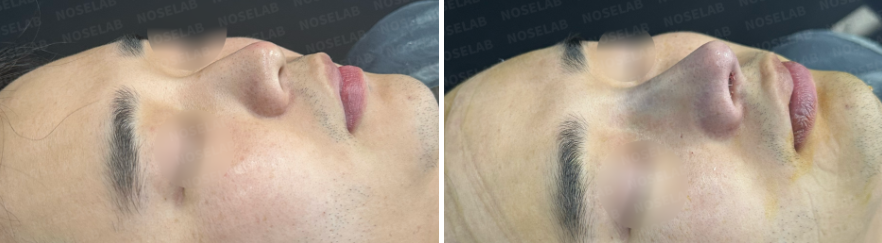 Before and after comparison – oblique side view of a short and wide male nose before surgery (left) and immediate results after Male Rhinoplasty Korea with closed rhinoplasty (right), highlighting stronger nasal bridge, refined tip, and masculine profile.
