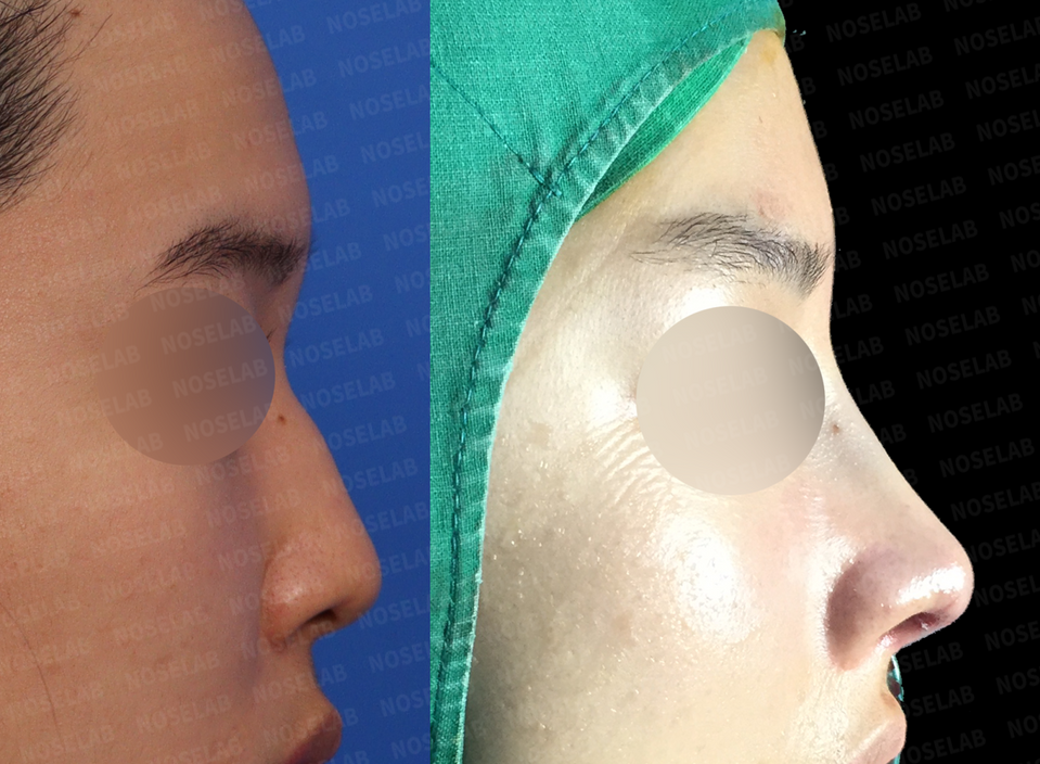 closed rhinoplasty Korea before and after side view – short and hump nose correction using self rib cartilage, improved nasal bridge and tip balance
