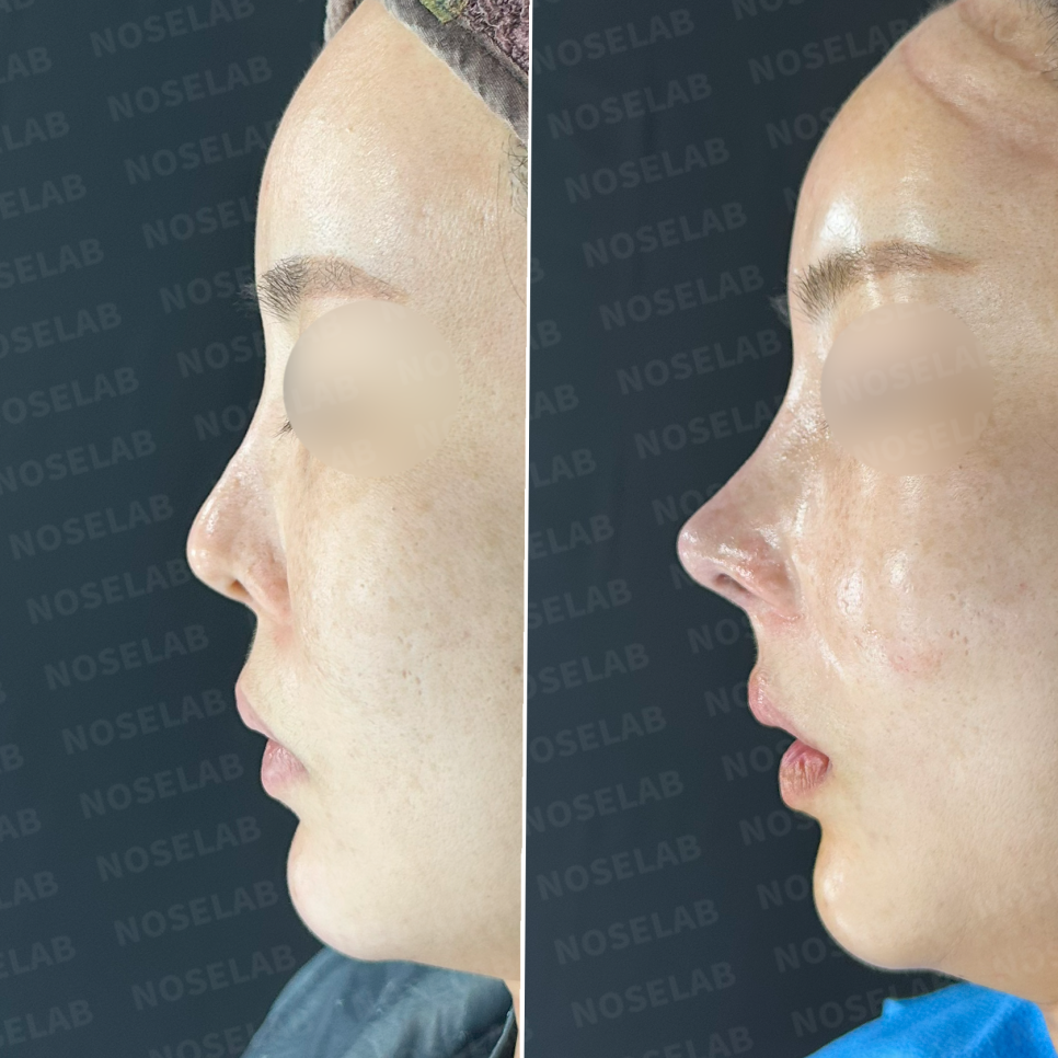 Before and after revision rhinoplasty: side profile photos showing improved nasal projection and corrected upturned tip.